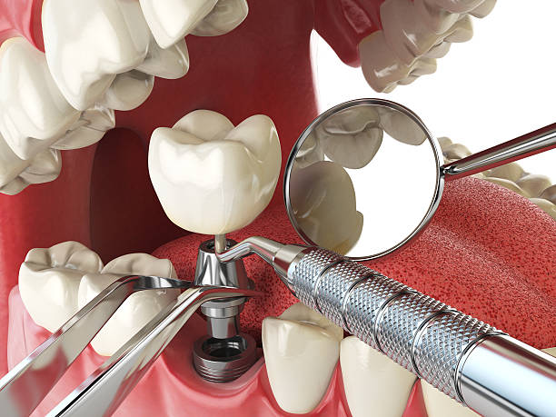 Best Emergency Dental Care for Broken or Chipped Teeth in Bridgeport, NE